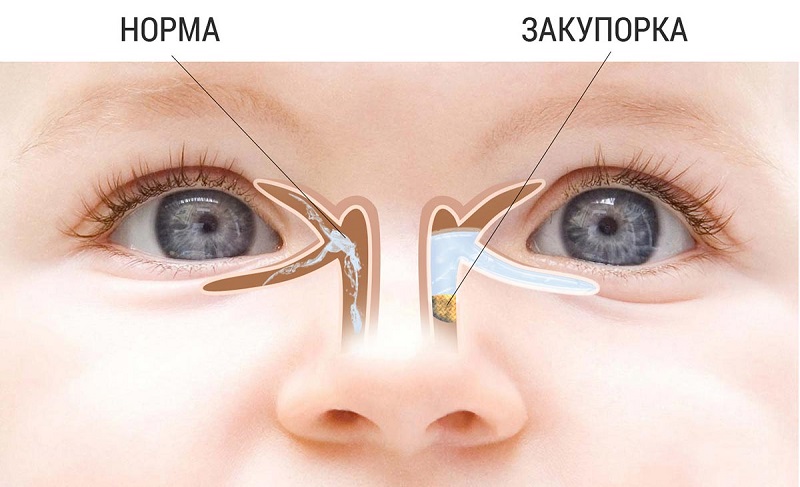 дакриоцистит.jpg дакриоцистит.jpg